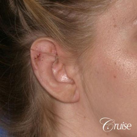 best otoplasty photos by top plastic surgeon - After Image 2