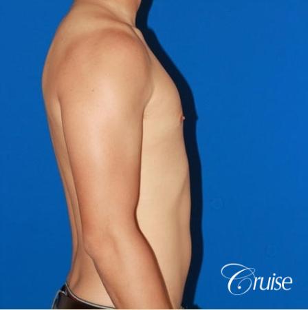 young athletic adult with puffy nipple - After Image 3