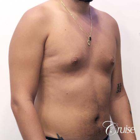 gynecomastia correction orange county - Before and After Image 5