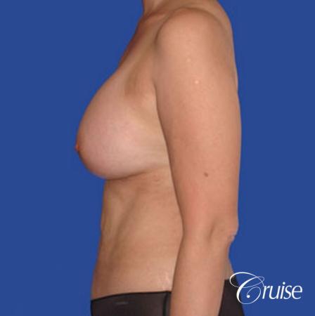 best mini mommy makeover with silicone breast implants - After Image 2