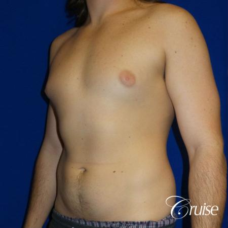 Type 2 Gynecomastia Glandular Removal - Before Image 2