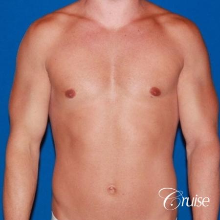32 yo with Gynecomatia and Puffy Nipple - After Image 1
