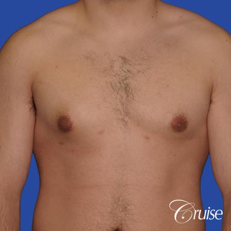 mild case of gynecomastia on adult - After Image 1