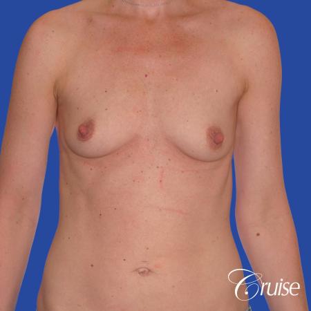 Breast Augmentation - Before Image 1