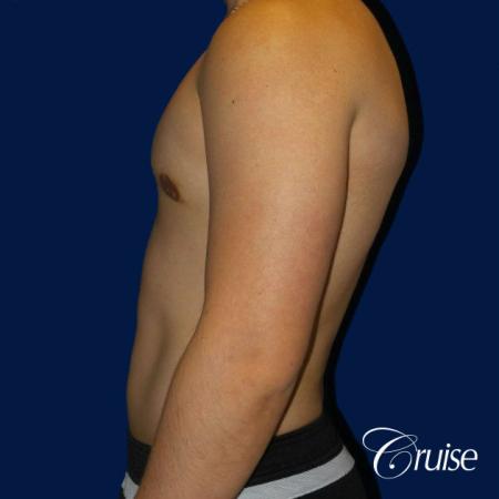 Best Gynecomastia surgeons Southern California - After Image 2