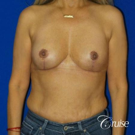 Best Breast reduction results and recovery - After Image 1