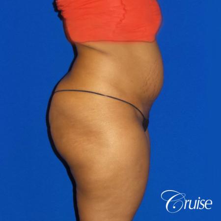 Best Tummy Tuck surgeons Newport Beach - Before Image 4