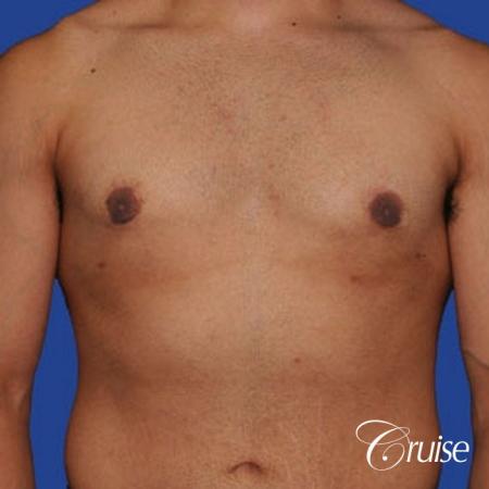 minor gyne young adult with best scars - After Image 1