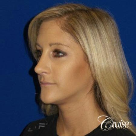 Best Rhinoplasty results Newport Beach CA - After Image 3