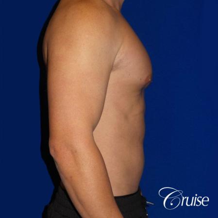 Gynecomastia puffy nipples cost - Before and After Image 3