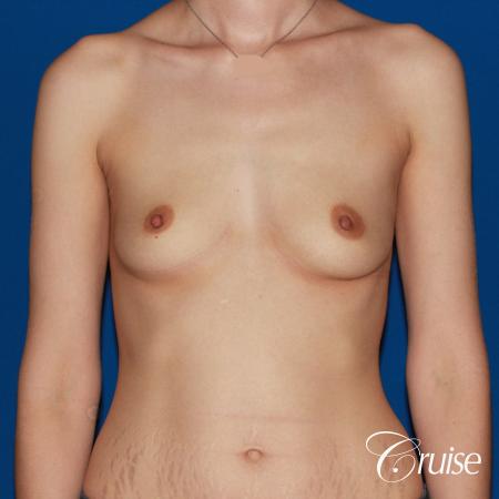 Breast Augmentation - Before 1