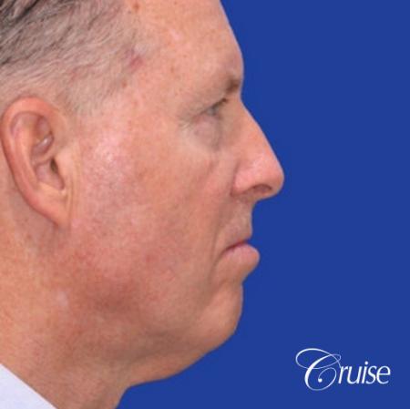 62 year old with chin implant and neck lift - Before and After Image 3