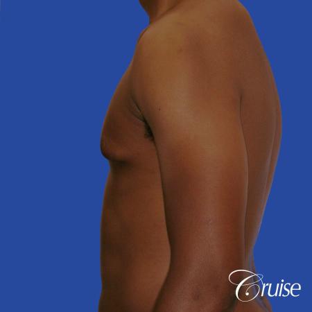 young body builder has puffy nipple and gets gynecomastia surgery - Before Image 2