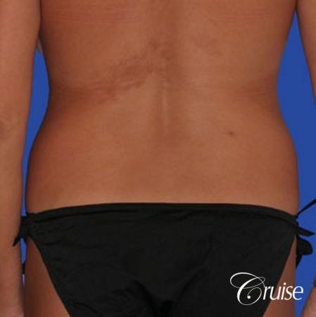 best female lipo results - Before Image