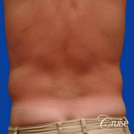 best male ab sculpting liposuction abdomen flanks - Before and After Image 3