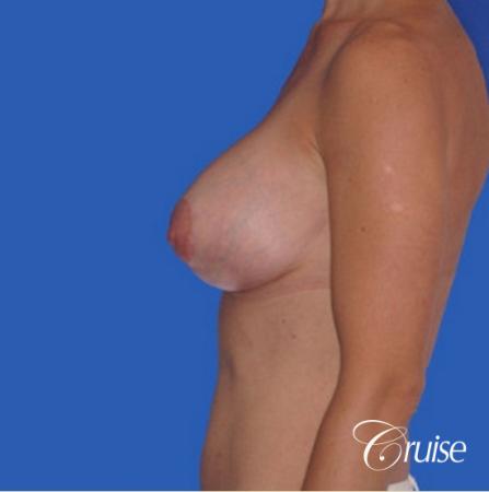 best breast lift anchor with silicone implants - After Image 2