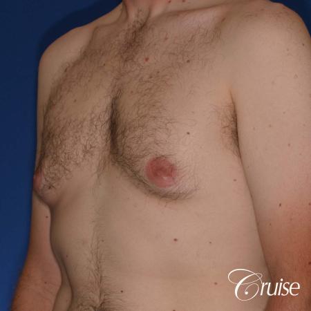 adult male with moderate gynecomastia gets donut lift - Before Image 3