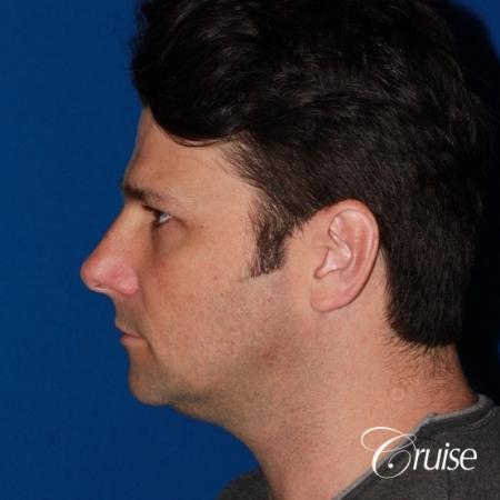 best medium terino square implant before and after pictures - Before Image 2