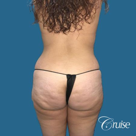 Extended Tummy Tuck, BBL, Breast Lift Anchor With Silicone - Before and After 4
