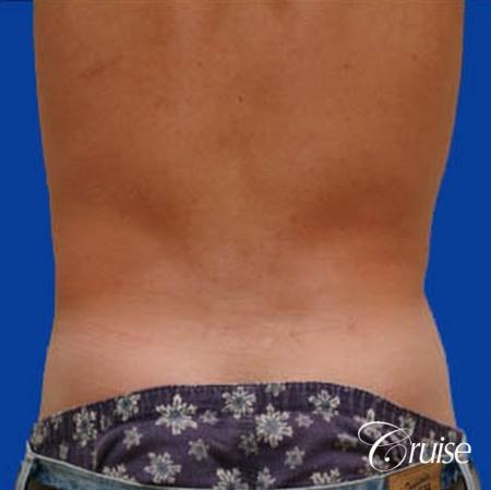 best male ab sculpting liposuction abdomen flanks - After Image 3