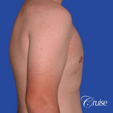 mild gynecomastia with puffy nipple from puberty - After Image 2