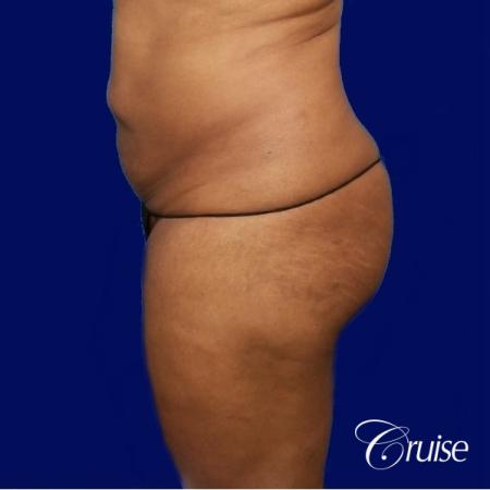 Liposuction Flanks - Before Image 2