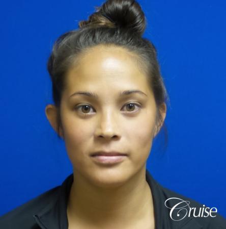 Otoplasty - Before Image 1