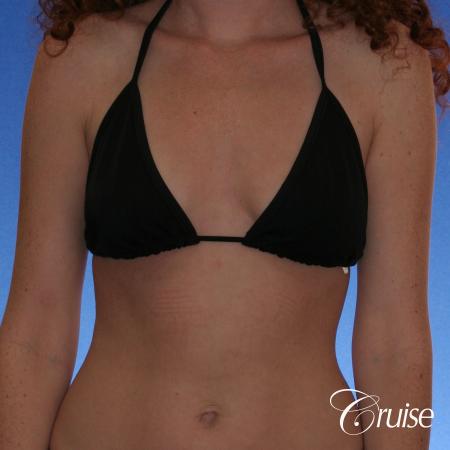 Breast Augmentation - Before and After Image 4