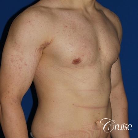 mild-gynecomastia-revision - After Image 3