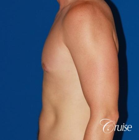 puffy nipple on 35 yr old male - After Image 2