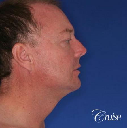 best male chin implant with large square jaw - After Image 2