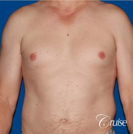 moderate gyne on mature adult 49 - Before Image 1