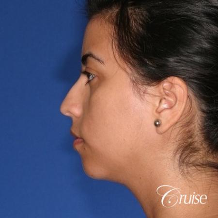 best XL chin implant on female patient - Before Image 2