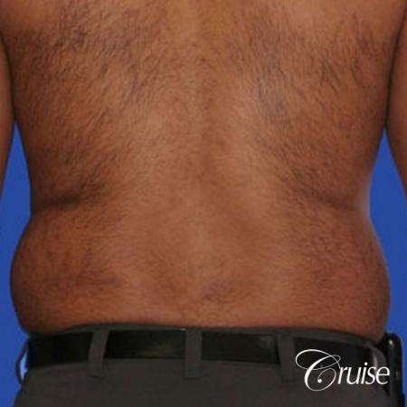 best liposuction abdomen and flanks on a male patient - Before Image 2