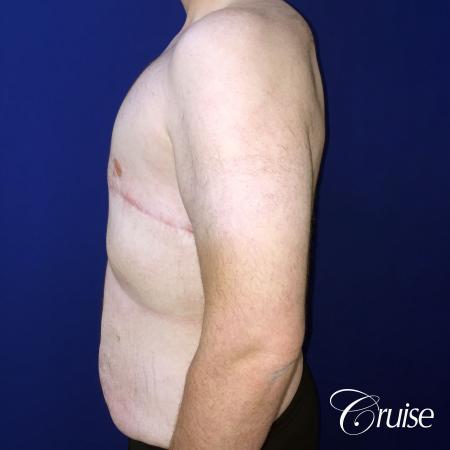 severe gynecomastia - After Image 4