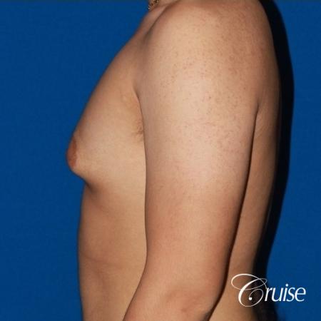 puffy nipple male breast on young adult - Before Image 2