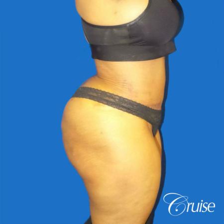 Best Tummy Tuck surgeons Newport Beach - After Image 4