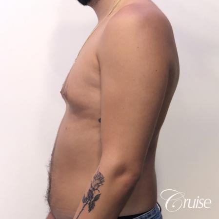gynecomastia correction orange county - Before Image 2