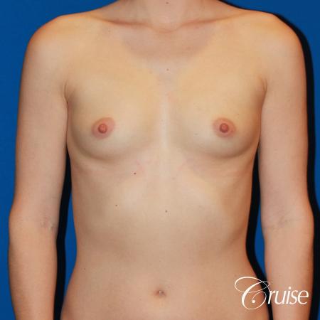 Breast Augmentation - Before Image 1