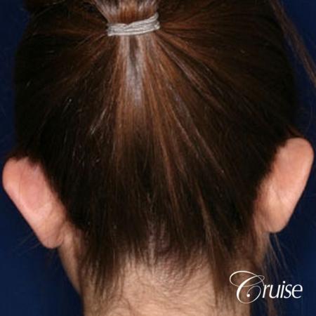 best otoplasty on kids - Before Image 1