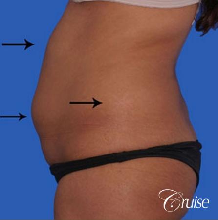 small waist with liposuction abdomen and flanks - Before and After Image 2