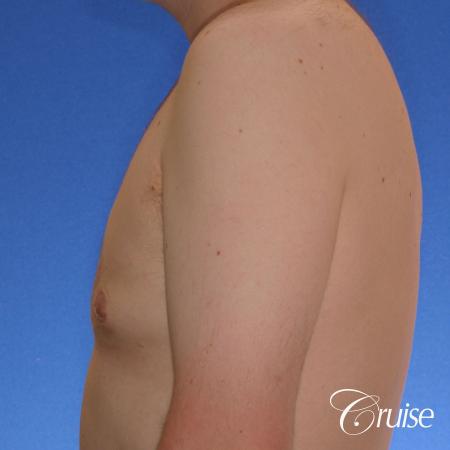 moderate gyne on 31 yr old male - After Image 2