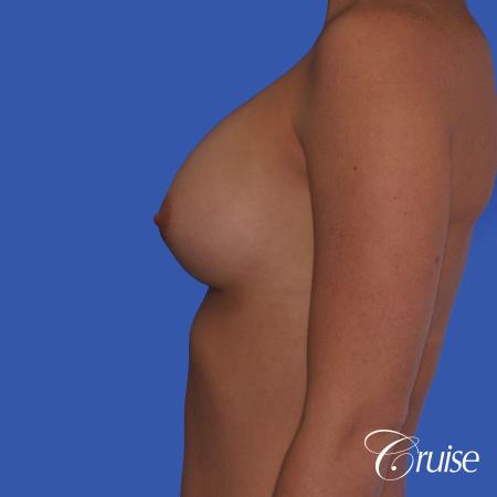 Breast Augmentation - After Image 2
