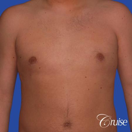 best puffy nipple gynecomastia results with plastic surgeon, Joseph Cruise, M.D. - After Image 1