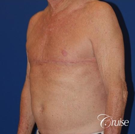 free nipple graft gynecomastia on old man - After Image 2