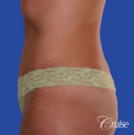 liposuction abdomen flanks with tummy tuck - After Image 2