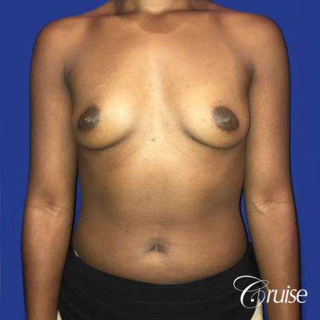 Breast Augmentation surgery Dr. Cruise - Before Image 1