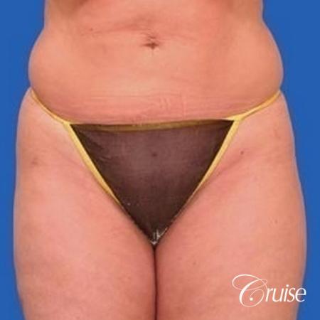 best liposuction abdomen, flanks and thighs - After Image 1