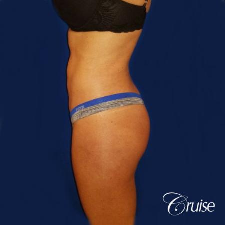 Brazilian Butt Lift Dr. Cruise - After Image 2