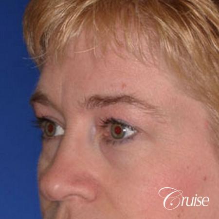 best specialist for upper eyelid surgery - Before Image 3